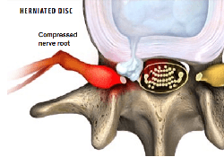 Disc herniation